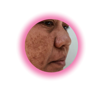 Skin Damage From Sun And Pollution